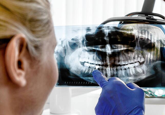 3000 Euro kann ein Implantat locker kosten. Außergewöhnlich hohe Heil- und Gesundheitskosten kann man beim Finanzamt einreichen.