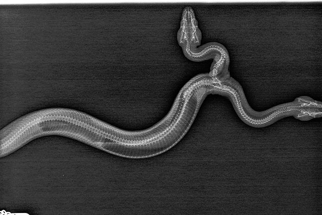 Das Röntgenbild zeigt die Anatomie der seltenen Schlangenmutation. Auf dem Bild ist auch zu erkennen, dass sich die beiden Speiseröhren ...