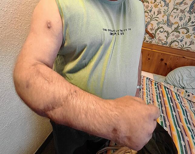 Äußerlich ist nach der Operation nur eine Narbe zurückgeblieben. Doch die Beweglichkeit des Arms und der Hand ist noch immer begrenzt.