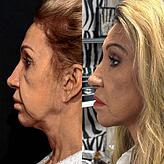 Carmen Geiss vor (links) und nach dem Facelift (rechts).