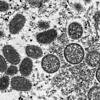 Das Affenpocken-Virus unter dem Mikroskop. Nun wurde es auch bei einem Mann in München nachgewiesen.