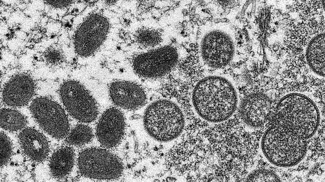 Das Affenpocken-Virus unter dem Mikroskop. Nun wurde es auch bei einem Mann in München nachgewiesen.