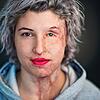 Das Säureopfer Vanessa Münstermann ein Jahr nach dem Angriff in einem Fotostudio in Hannover (Niedersachsen). Anders als andere ...