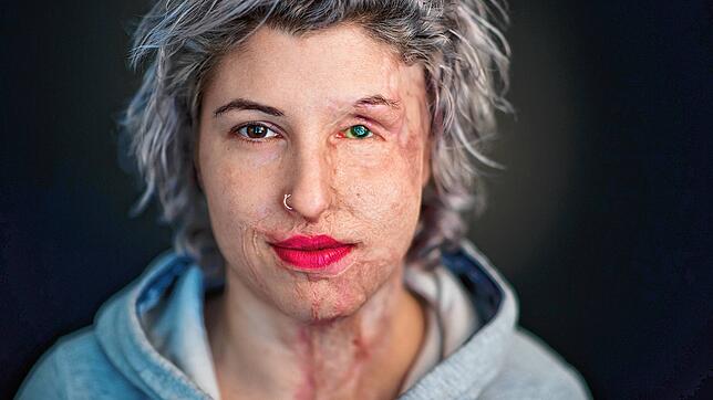 Das Säureopfer Vanessa Münstermann ein Jahr nach dem Angriff in einem Fotostudio in Hannover (Niedersachsen). Anders als andere ...