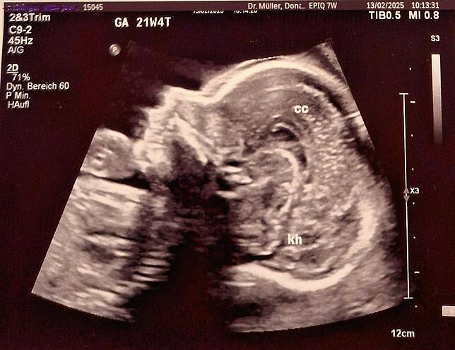 Die Pränataldiagnostik ist weit mehr als Baby-Fernsehen. Sie ermöglicht die gründliche Untersuchung des Ungeborenen nach Hinweisen auf ...