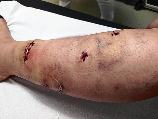 Diese Aufnahme zeigt die Verletzungen von Tina Fien, als diese nach der Hundeattacke im Krankenhaus mit fünf Stichen genäht wurden. Bei ...