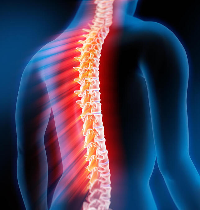 Brennpunkt Rückgrat: Axiale Spondyloarthritis (SpA), die im fortgeschrittenen Stadium Morbus Bechterew heisst, kann sehr schmerzhaft ...