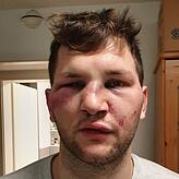 Marco Boxler am Tag nach der Tat. Er erlitt schwere Verletzungen im Gesicht. Inzwischen wurde er operiert.