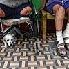 Lepra ist bis heute nicht ganz besiegt. Diese beiden Patienten warten in einem Gang des Curupaiti-Krankenhauses in Rio de Janeiro.