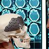 Modell eines Schädels mit Implantat. Es drohen Engpässe in der Medizintechnik. Bild: dpa