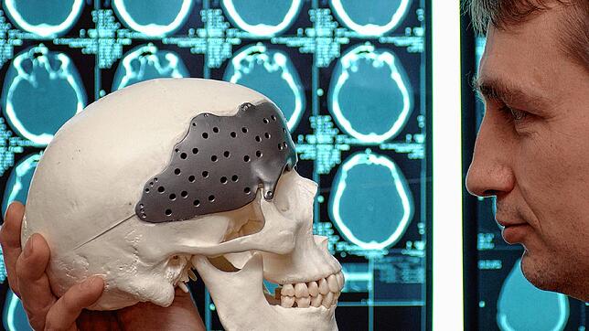 Modell eines Schädels mit Implantat. Es drohen Engpässe in der Medizintechnik. Bild: dpa