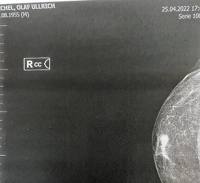 Röntgenaufnahme des Karzinoms von Olaf Michel. Der weiße Tumor ist gut zu erkennen.