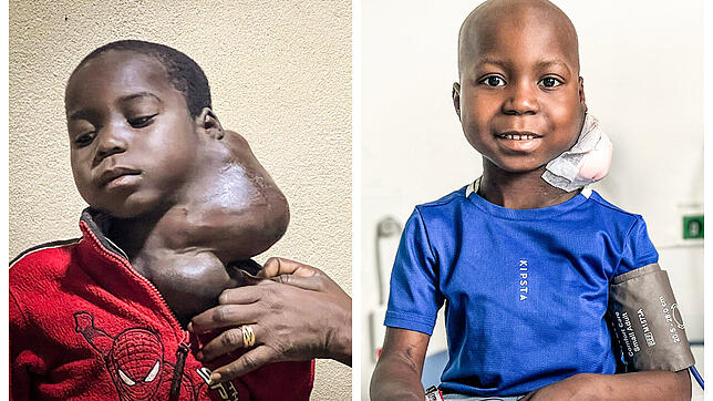 Die Therapie des fünfjährigen Daniel aus Kamerun zeigt enorme Fortschritte: Links ist Daniel Anfang 2023 zu sehen, rechts Mitte Mai ...