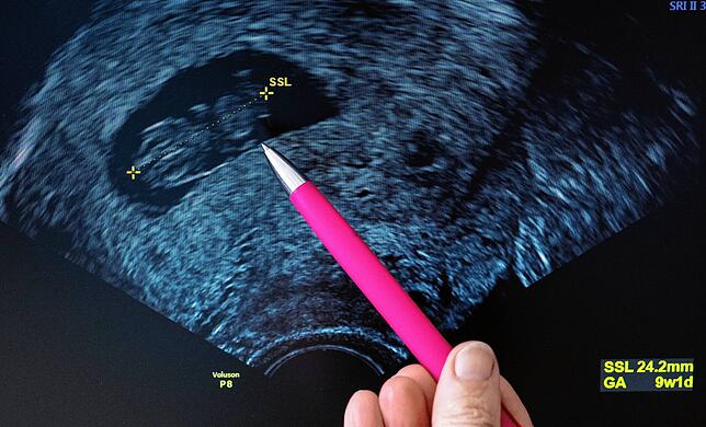 Eine Frauenärztin deutet auf den Kopf eines Fötus im Ultraschall, dessen Scheitel-Steiß-Länge auf eine Schwangerschaftsdauer von etwa 9 ...