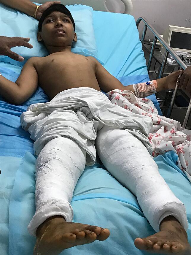 Erfolg: Bei diesem Patienten wurden alle Beugesehnen in den Kniekehlen verlängert. Erstmals hat das Kind gestreckte Beine. Die ...