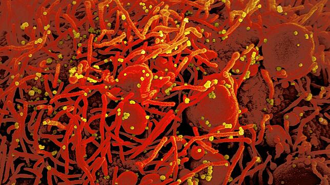 Eine rot gefärbte Zelle ist mit dem Coronavirus infiziert (gelb): Welche Folgen könnte eine zweite Pandemiewelle haben? Antworten ...