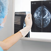 Das Röntgenbild einer mammographierten Brust: Es ist das Standardverfahren zur Brustkrebserkennung.