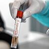 Die Corona-Probe: Auch Ärzte können sich am Virus infizieren. Dies ist dem in Radolfzell tätigen Dermatologen Andras Roszondai passiert. ...
