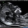 Ultraschall Bild Pränataldiagnostik