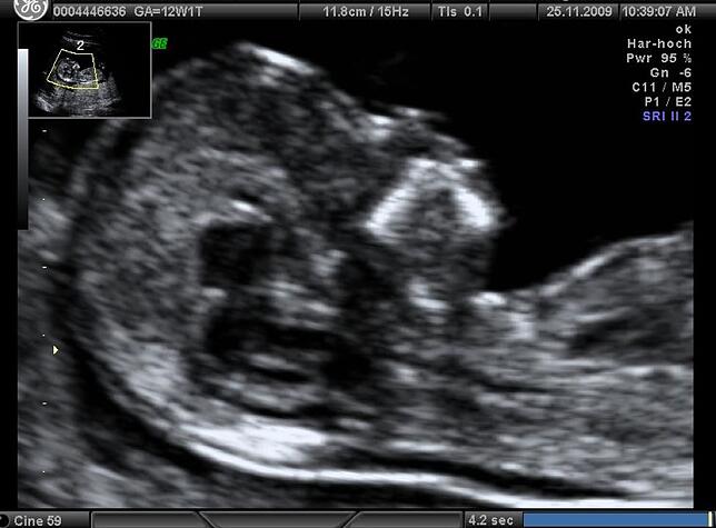 Ultraschall Bild Pränataldiagnostik