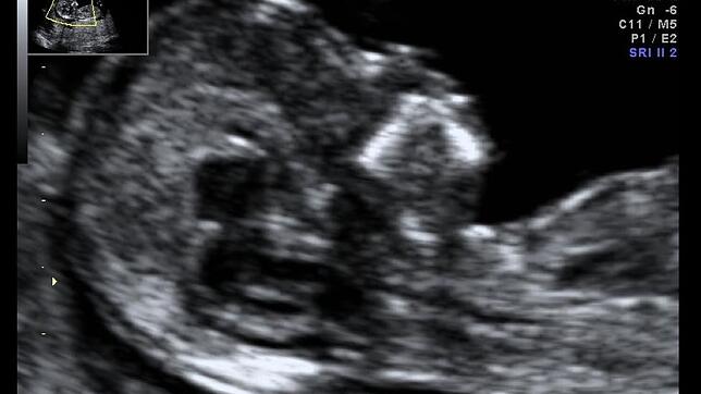 Ultraschall Bild Pränataldiagnostik