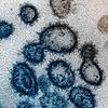 Das Coronavirus SARS-CoV-2 unter dem Elektrononmikroskop, hier eine Probe eines US-amerikanischen Patienten. Bild: NIAID-RML/AP/dpa