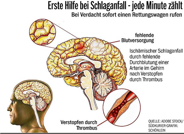 Bild 2: Die Angst vor dem Schlaganfall: Etwa zwei Millionen Deutsche haben ein nicht eingerissenes Aneurysma im Gehirn. Sind sie dadurch für die Erkrankung besonders gefährdet?