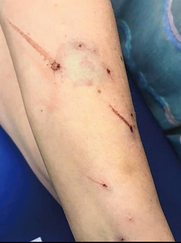 So sieht Kathrin Behrendts Arm kurz nach dem Katzenbiss aus.