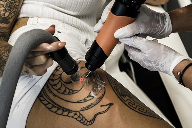 Ein Tattoo wird mit einer Laserbehandlung entfernt. Auch das birgt Risiken, etwa mögliche Verbrennungen.