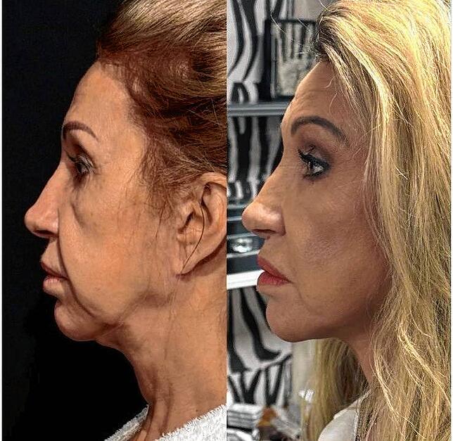 Carmen Geiss vor und nach ihrem Facelift.