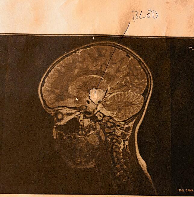 Ein erstes Biopsie-Bild zeigt den Hirntumor im Kopf von Yara Assis Jordan.