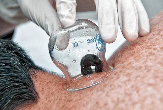 In einem kleinen Glas setzt Bianca Seitler einen Blutegel auf die gewünschte Stelle im Nacken ihres Patienten und wartet, bis dieser ...