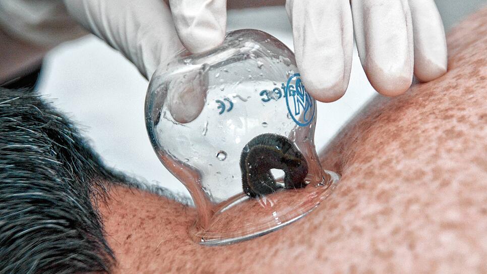 In einem kleinen Glas setzt Bianca Seitler einen Blutegel auf die gewünschte Stelle im Nacken ihres Patienten und wartet, bis dieser ...