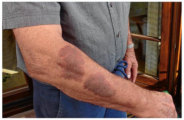 Die Folgen des Vorfalls: Hämatome an Klaus Krombholz Arm nach dem Zugriff durch die Polizeibeamten. War dieser wirklich angemessen?